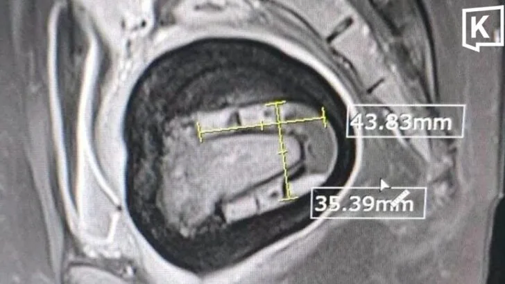 Doctors Remove Stone-Like Mass From Woman's Body