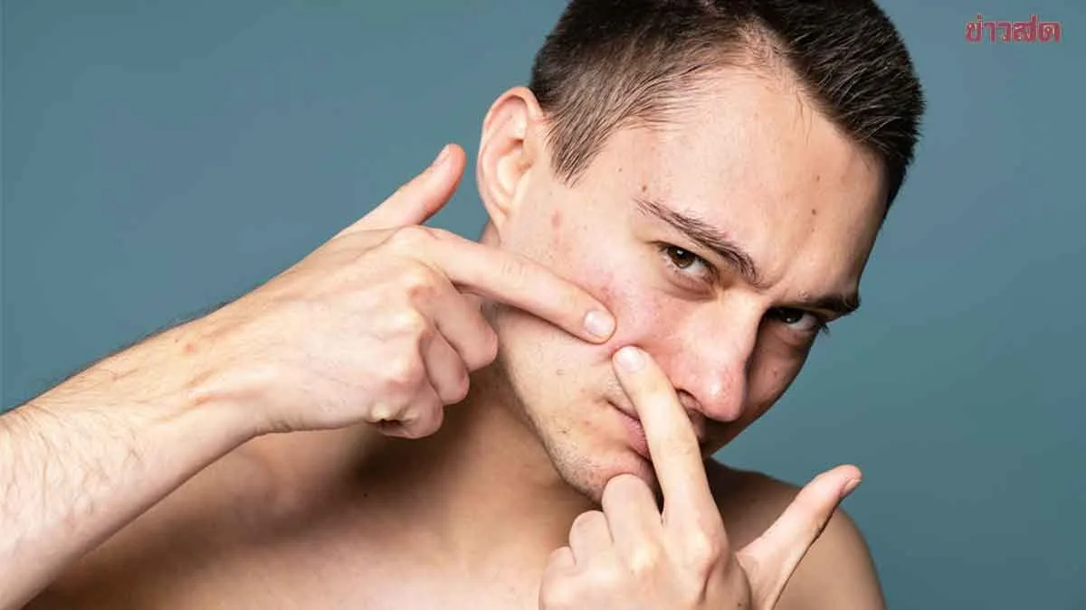 Safe Ways To Extract Clogged Pores At Home